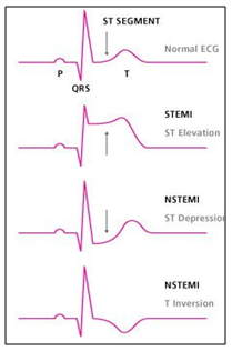 Would Heart Disease Show Up On An Ecg - Cardiovascular Disease