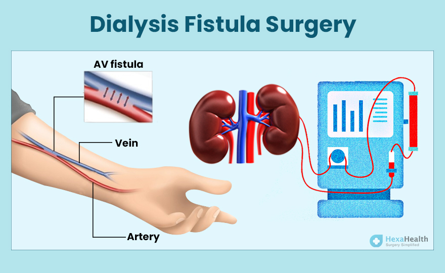 Dialysis Fistula Surgery