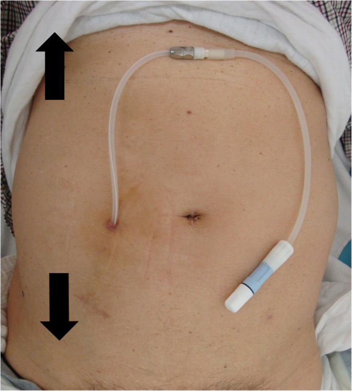 Peritoneal Dialysis