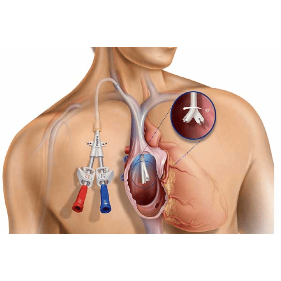 IJ Catheter Surgery